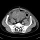 Crohn's disease of small bowel, abdominal abscess: CT - Computed tomography